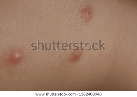  insect bites on  skin  child