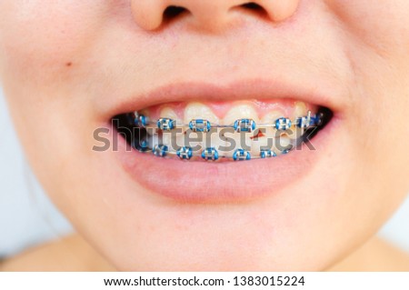 Close up of Asian girl teeth with braces on white background Royalty-Free Stock Photo #1383015224