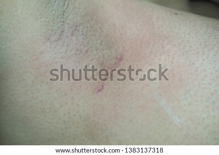 The Surgical wound at the armpit from the Sentinel lymph node biopsy, the part of Breast cancer treatment (Partial mastectomy). Royalty-Free Stock Photo #1383137318