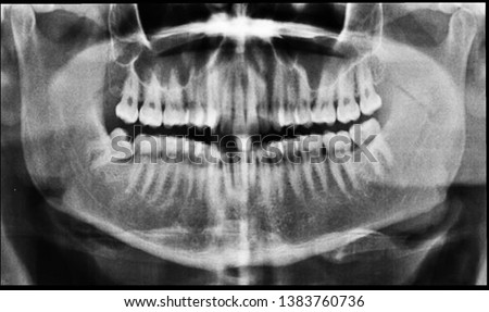 oral x ray scan of a patient with wisdom tooth misplaced    