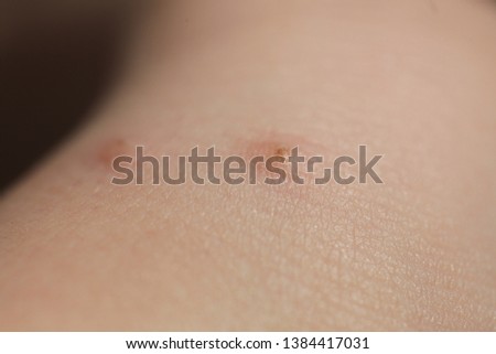 insect bites on  skin  child