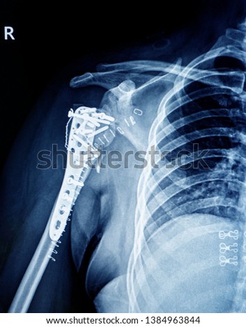  X-ray image of  human right shoulder                              