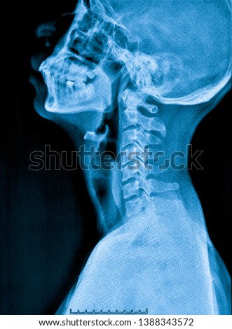X-ray of the cervical spine in men