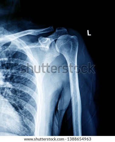  X-ray image of  human left shoulder                              
