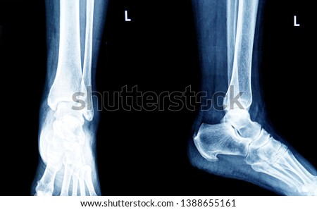  x-ray of human foot and ankle                              