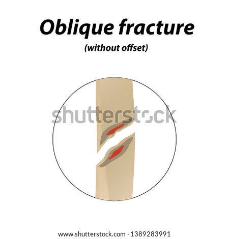 Oblique, without offset bone fracture. Infographics. illustration on a lined background.