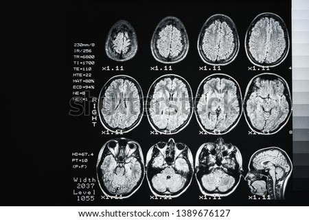MRI of  brain of a healthy person on a black background with gray illumination. Magnetic resonance scan. Medical healthcare concept