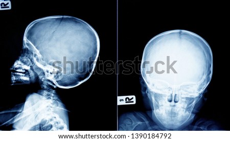 Film x-ray skull ,human's skull