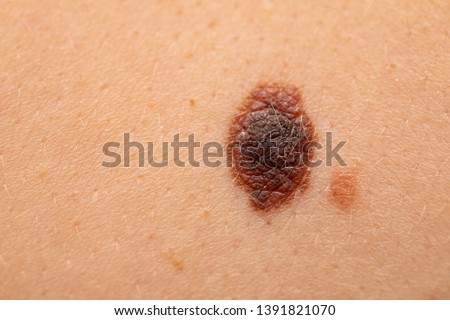 Close up picture of dangerous brown nevus on human skin - melanoma