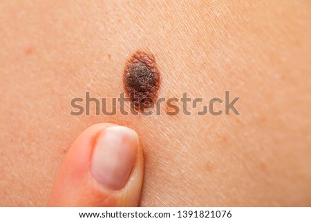 Close up picture of finger pointing at dangerous brown nevus on human skin - melanoma