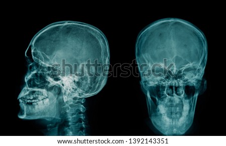 x-ray image of human skull 