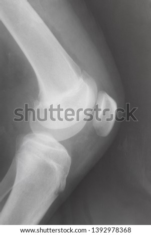 side view of human knee-joint with kneecap on X-ray image