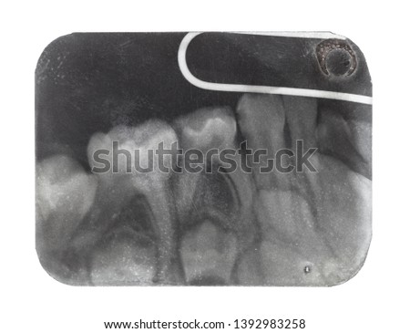 film with X-ray image of human teeth close up isolated on white background