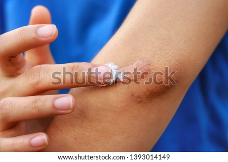 Close up at Asian woman's hand is applying medical cream at  keloid scar (Hypertrophic Scar) at her elbow cause by bicycle accidental.Concepts of health care and beauty. Royalty-Free Stock Photo #1393014149