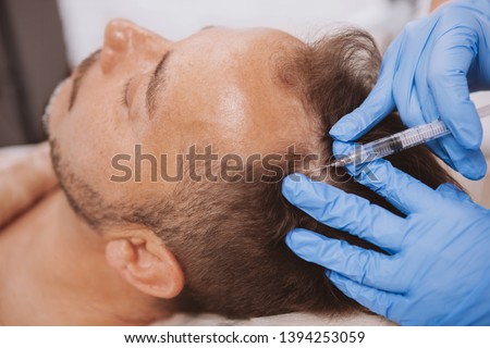 Close up of a mature man receiving hairloss treatment injections in scalp by professional trichologist. Dermatologist doing scalp injections for mature male client with alopecia problem Royalty-Free Stock Photo #1394253059