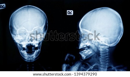 Film x-ray skull ,human's skull, Blue light film
