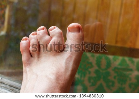 deformity of toes because of dyschondroplasia, which causing distorted growth in length, tumors of bone and pathologic fractures with enchondromas. The picture showed toes deformity of foot.
