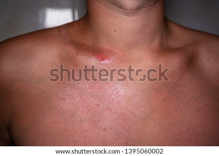 man with reddened, itchy skin after sunburn.