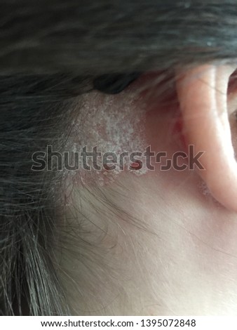 Plaque psoriasis behind the ear of a teenage girl with glasses