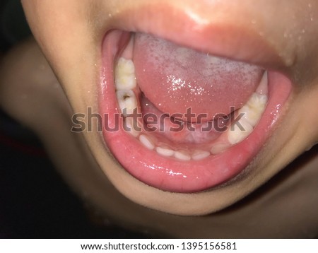 kid patient open mouth showing caries teeth decay 