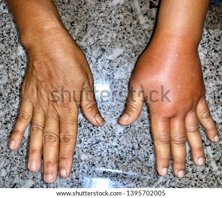 Comparison of normal right hand to Left Swollen and red hand caused by allergic reaction after insect bite in adult female patient in clinic of Myanmar. also called lymphedema. Royalty-Free Stock Photo #1395702005