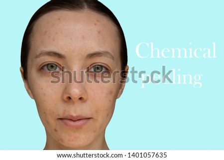 Face of a young girl after a cosmetic procedure of chemical peeling close-up.
