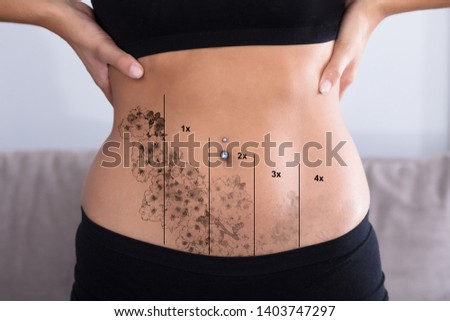 Close-up Of Laser Tattoo Removal On Woman's Stomach With Piercing Royalty-Free Stock Photo #1403747297