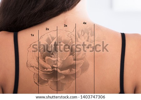 Close-up Of Laser Tattoo Removal On Woman's Back Against White Background Royalty-Free Stock Photo #1403747306