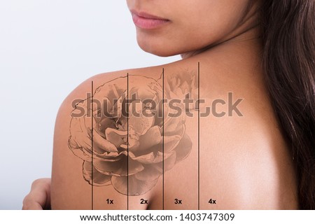 Laser Tattoo Removal On Woman's Shoulder Against White Background Royalty-Free Stock Photo #1403747309