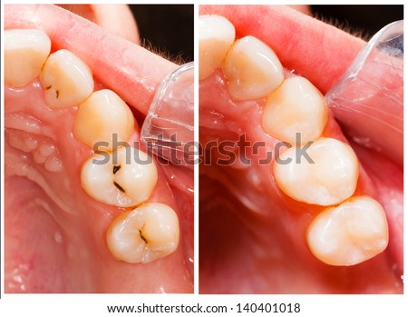 Teeth before and after treatment - dental composite filling. Royalty-Free Stock Photo #140401018