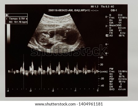 Ultrasound scan of future baby with heart beat parameters 