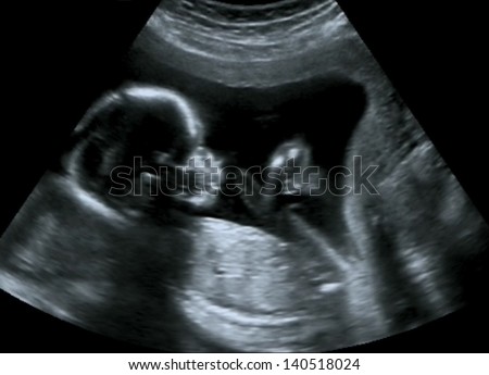 Obstetric Ultrasound of fetus at fourth month. Echography Scan. Royalty-Free Stock Photo #140518024