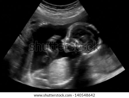 Obstetric Ultrasonography Ultrasound Echography of a fourth month fetus Royalty-Free Stock Photo #140548642
