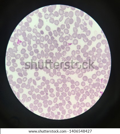 Poikilocytosis is variation in cell shape: poikilocytes may be oval, teardrop-shaped, sickle-shaped or irregularly contracted. Royalty-Free Stock Photo #1406548427