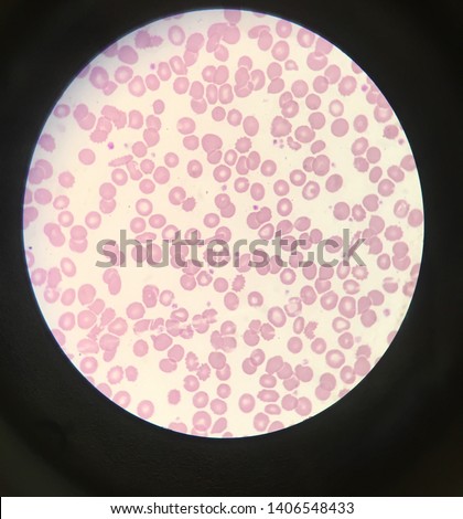 Poikilocytosis is variation in cell shape: poikilocytes may be oval, teardrop-shaped, sickle-shaped or irregularly contracted. Royalty-Free Stock Photo #1406548433
