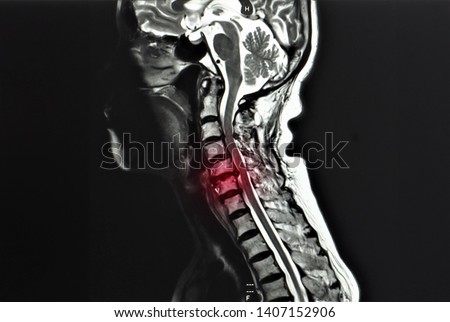 sagittal view magnetic resonance image or MRI of cervical spine showing cervical spondylosis and spinal cord compression at C5/6 level. the disease cause neck pain and radiculopathy.  Royalty-Free Stock Photo #1407152906