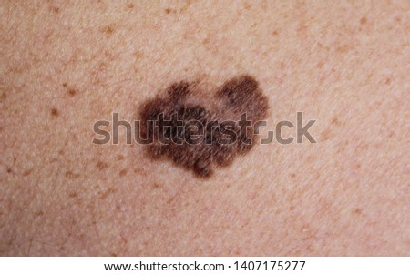 melanoma - a malignant tumor of the skin Royalty-Free Stock Photo #1407175277