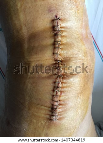 image of the knee after orthopaedic surgery.Health,Medicine,Surgery 
