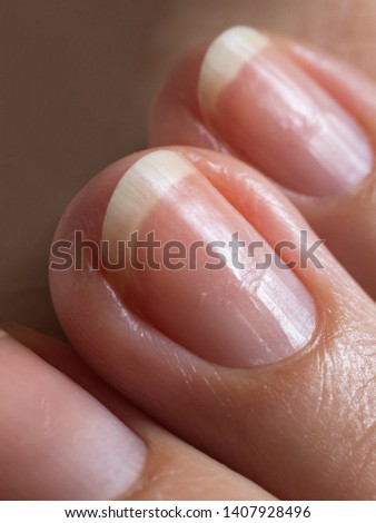 Damaged nails after gel polish. Close up. 