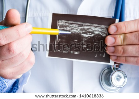 Achondroplasia on ultrasound image concept photo. Doctor indicating by pen on printed picture ultrasound pathology - achondroplasia or hypochondroplasia. Photo for diagnosis, radiology