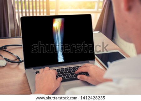 Doctor watching a laptop with x-ray of leg with pain in the external knee. Radiology concept