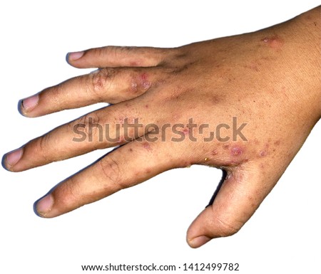 Scabies Infestation in right hand of Southeast Asian, Burmese Child in Myanmar. It is a contagious skin condition caused by mites that burrow into skin. Isolated image with white background. Royalty-Free Stock Photo #1412499782