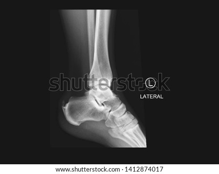 Film X-ray lateral ankle radiograph showing calcium deposit on Achilles tendon insertion (calcific tendinitis) and calcaneus bone spur (Haglund deformity). The calcified tendon cause heel pain. Royalty-Free Stock Photo #1412874017