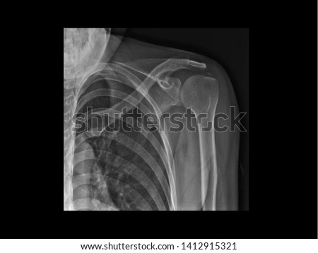 Film X-ray shoulder radiograph showing calcium deposit on supraspinatus of rotator cuff tendon (calcific tendinitis or tendinosis calcarea). This calcified tendon cause shoulder pain and stiffness. Royalty-Free Stock Photo #1412915321
