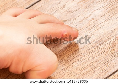 Closeup of foot with an infected wart placed on toe. Foot wart. Foot bottom pathology: verruca, wart, papilloma virus. Royalty-Free Stock Photo #1413729335