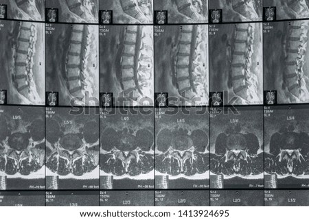 MRI scan of sacro lumbar spines of a patient. the Magnetic Resonance Imaging shows degenerative changes of L spines, lumbar discs herniation and nerve roots compression