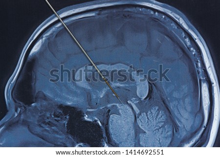 Concept of brain recording at subthalamic nucleus in parkinson surgery. Microelectrode recording on magnetic resonance imaging of human brain Royalty-Free Stock Photo #1414692551