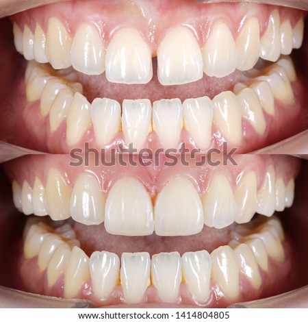 Diastema closures by direct composite filling Royalty-Free Stock Photo #1414804805