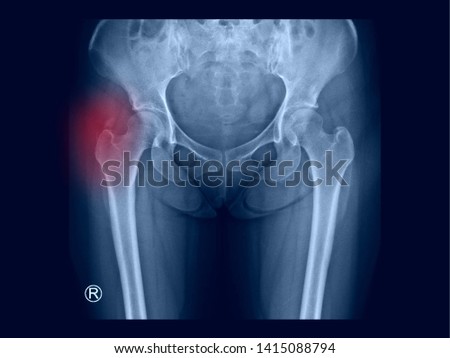 Film X-ray hip radiograph showing calcium deposit on abductor tendon of right hip(calcific tendinitis or tendinosis calcarea). This calcified tendon cause hip pain and stiffness. medical concept. Royalty-Free Stock Photo #1415088794