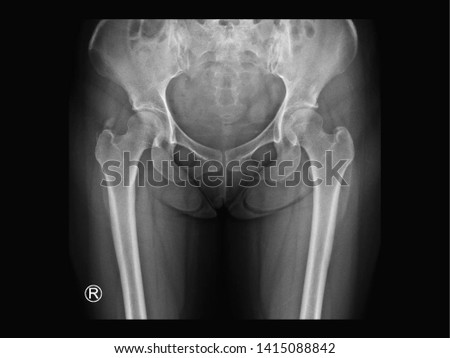Film X-ray hip radiograph showing calcium deposit on abductor tendon of right hip (calcific tendinitis or tendinosis calcarea). This calcified tendon cause hip pain and swelling. (R = right side). Royalty-Free Stock Photo #1415088842